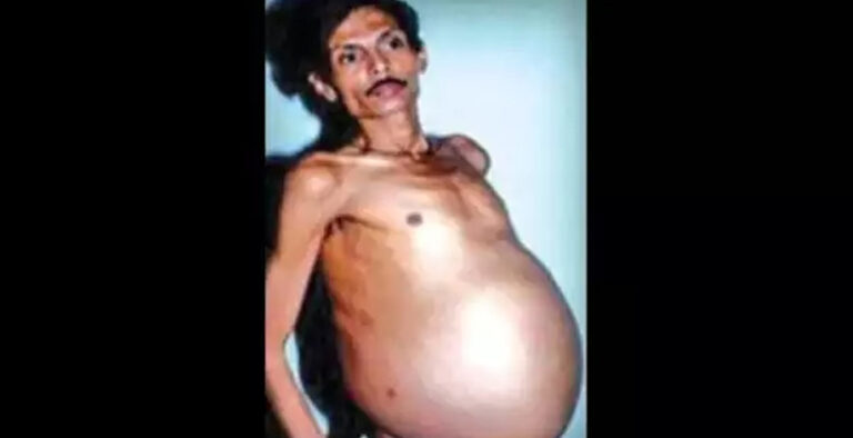Nagpur man, thought to be ‘Pregnant’, carried his twin for 36 years